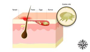 End Scabies Now